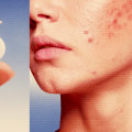 Effective Prescription Medications for Acne Management