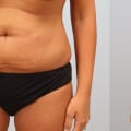 Transform Your Body: Exploring Tummy Tuck Procedures