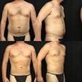 Understanding Liposuction Techniques for Effective Body Contouring