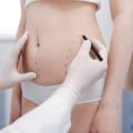 Understanding Ultrasound-Assisted Liposuction for Body Contouring