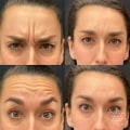 Understanding the Differences Between Botox and Fillers