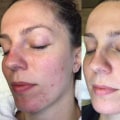 Transform Your Skin with Laser Treatments