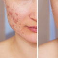 Effective Lifestyle Changes to Minimize Acne Breakouts