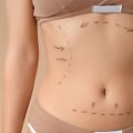Exploring the Spectrum of Body Contouring: Surgical vs. Non-Surgical Approaches