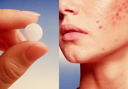 Effective Prescription Medications for Acne Management