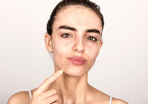 Understanding When to Seek Professional Help for Acne