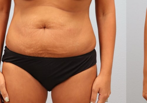 Transform Your Body: Exploring Tummy Tuck Procedures