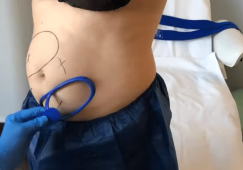 Understanding CoolSculpting: A Non-Invasive Body Contouring Solution