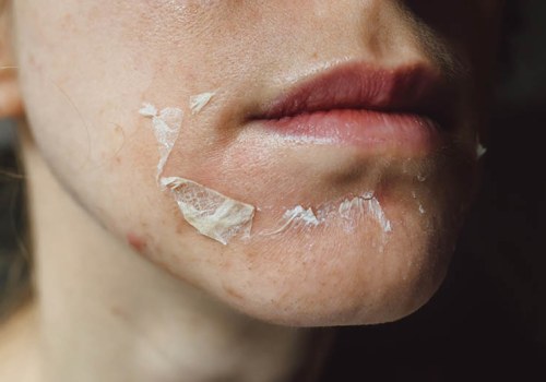 Essential Aftercare Tips for Chemical Peels
