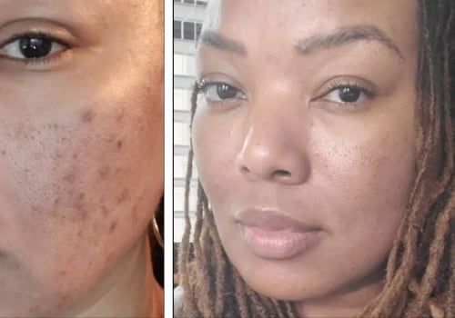 Understanding Superficial and Deep Chemical Peels