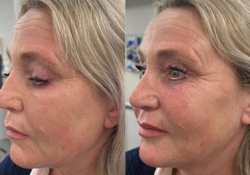 Exploring the Advantages of Dermal Fillers for a Youthful Appearance