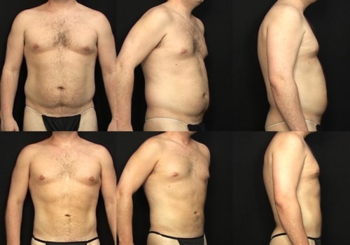 Understanding Liposuction Techniques for Effective Body Contouring