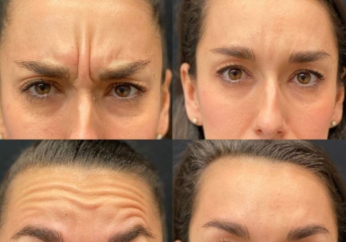 Understanding the Differences Between Botox and Fillers