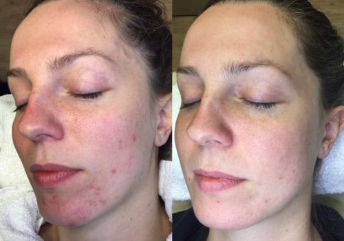 Transform Your Skin with Laser Treatments