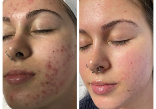 Effective Over-the-Counter Options for Acne Treatment