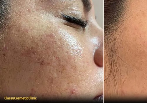 Transform Your Skin: The Power of Chemical Peels for Acne Treatment