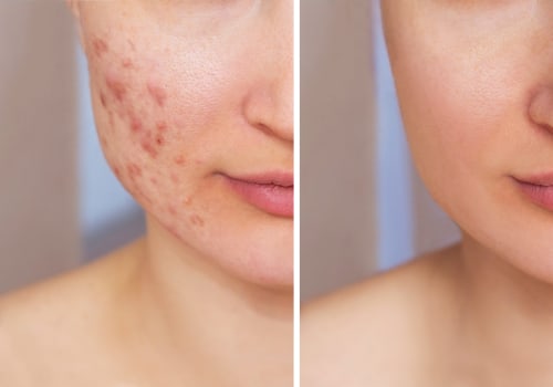 Effective Lifestyle Changes to Minimize Acne Breakouts