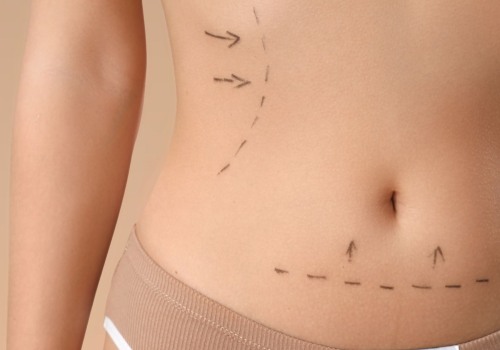 Exploring the Spectrum of Body Contouring: Surgical vs. Non-Surgical Approaches